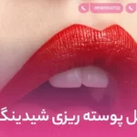 مراحل پوسته ریزی شیدینگ لب